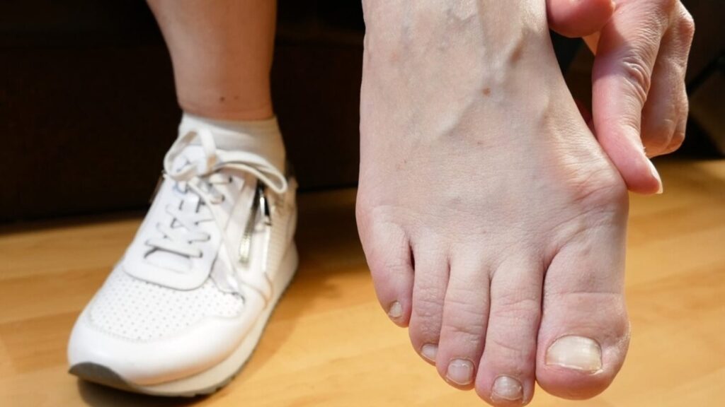 Are your shoes to blame? Doctor explains the link between footwear and bunion pain | Health