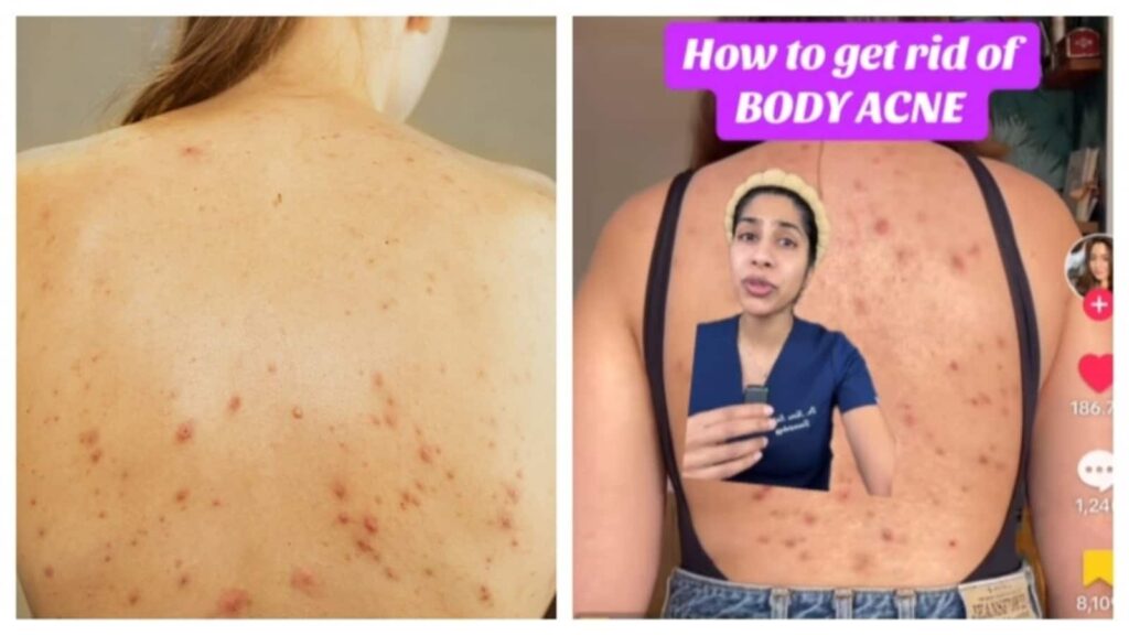 Back acne making you ditch your backless dress? Dermat shares skincare routine for effective treatment | Health