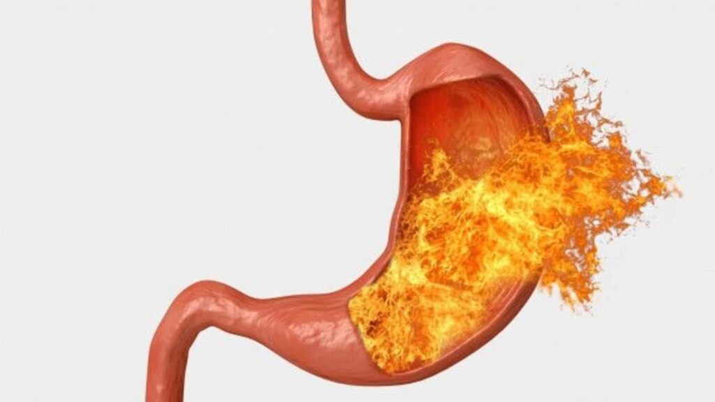 Diet, lifestyle hacks to say goodbye to acid reflux and protect yourself from oesophageal cancer | Health
