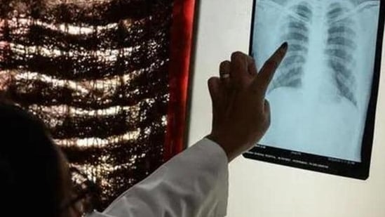 India’s 100-day TB challenge: A look at the progress so far