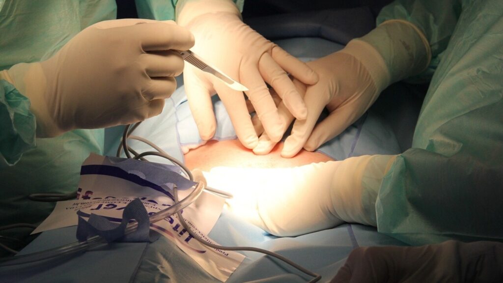 Karnataka doctor leaves surgical mop in woman’s stomach during C-section surgery: Report | Bengaluru