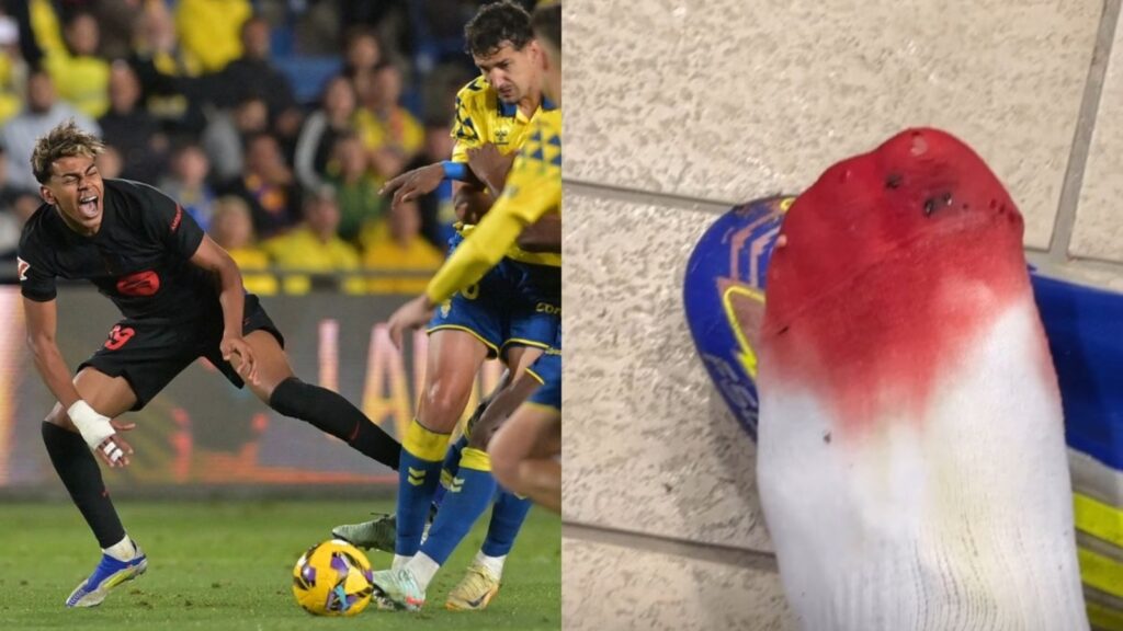 Lamine Yamal displays bloodied foot, takes dig at referring in LaLiga clash during Barcelona vs Las Palmas | Football News