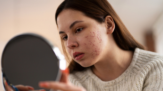 Struggling with acne-prone skin? Watch out for these 3 common mistakes you may be making | Health
