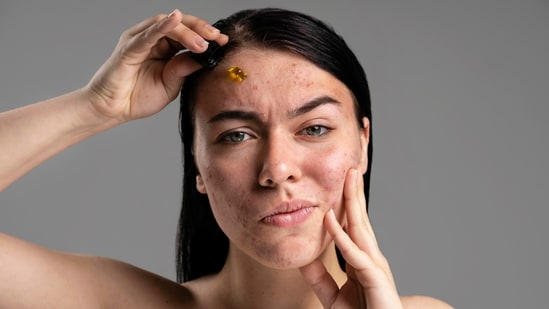 Tired of pigmentation? Follow this expert-recommended 5-step skincare regimen to protect, treat and brighten your skin | Health