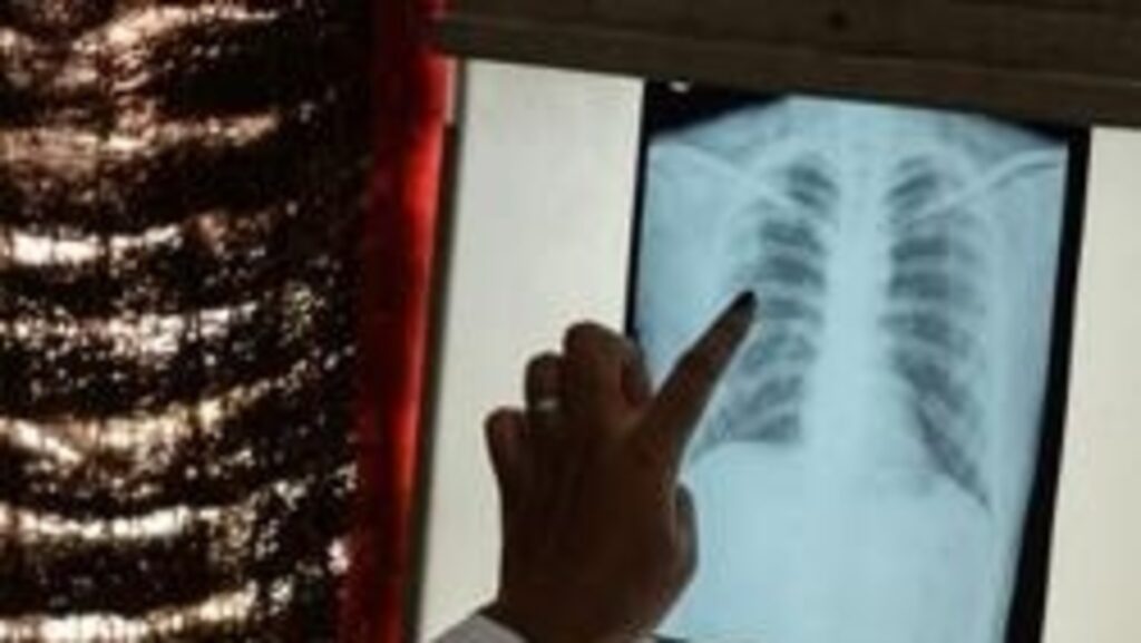 A journey towards patient-centred TB care
