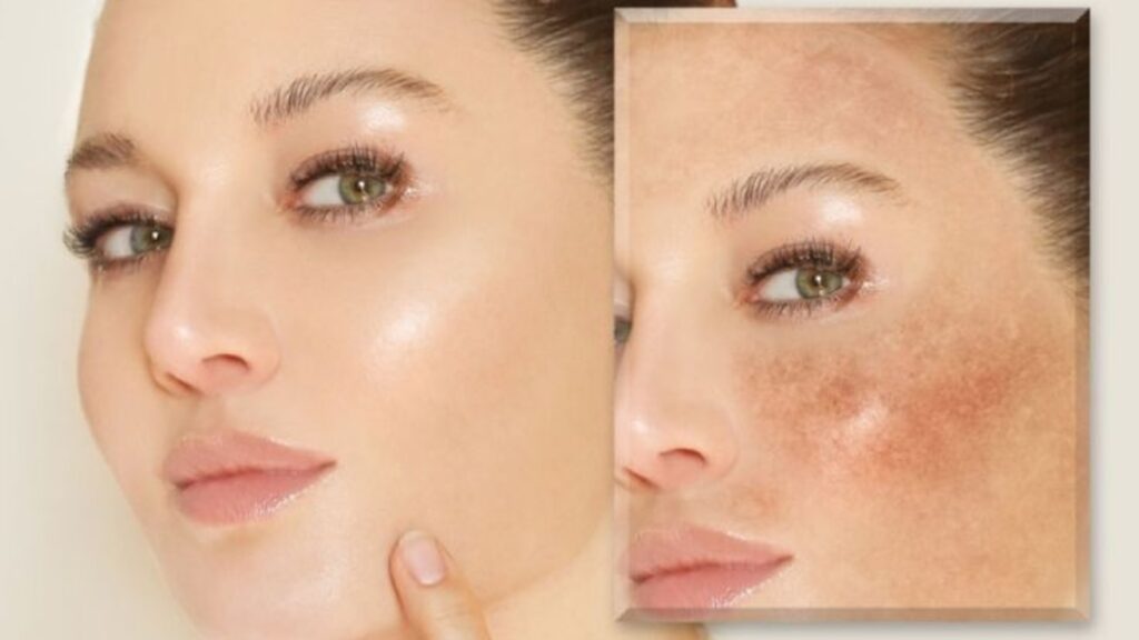 Are dark spots making you look older? Here’s how to reverse hyperpigmentation | Health