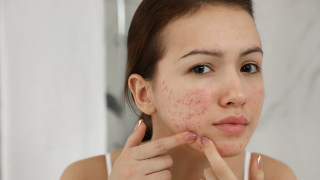 Beat the heat: Prevent acne and breakouts from sweaty skin with these skincare tips | Health
