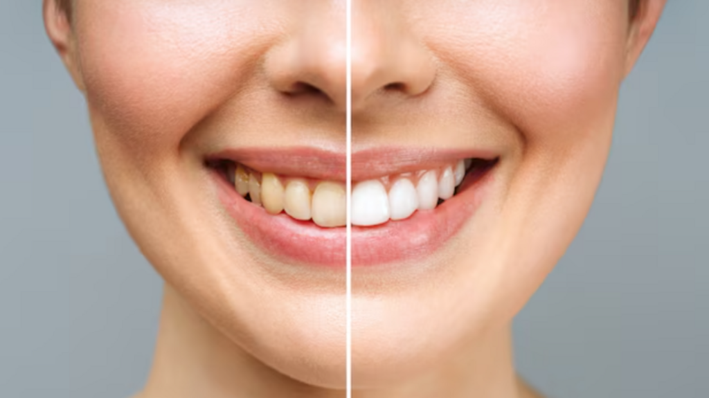 Can simply brushing your teeth make them whiter and brighter? Dentist shares most effective ways to whiten teeth | Health