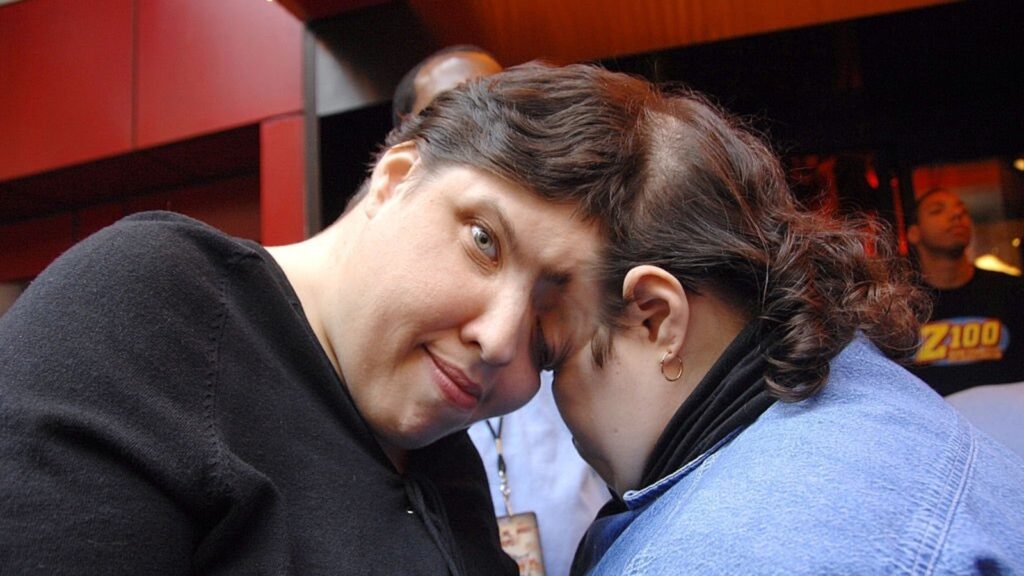 Conjoined twin kept gender identity secret from sister for decades: ‘I should have been…’ | Trending
