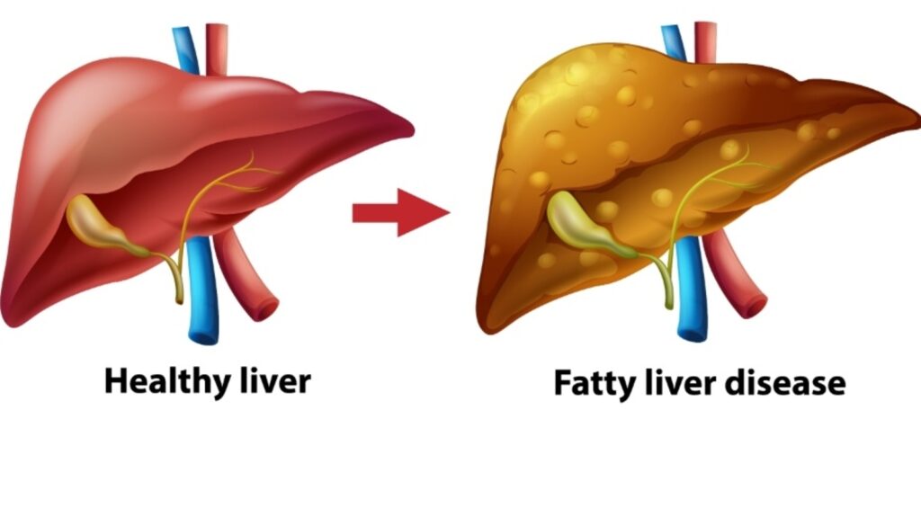 Fatty liver disease without symptoms? Here’s how to catch it before it is too late | Health
