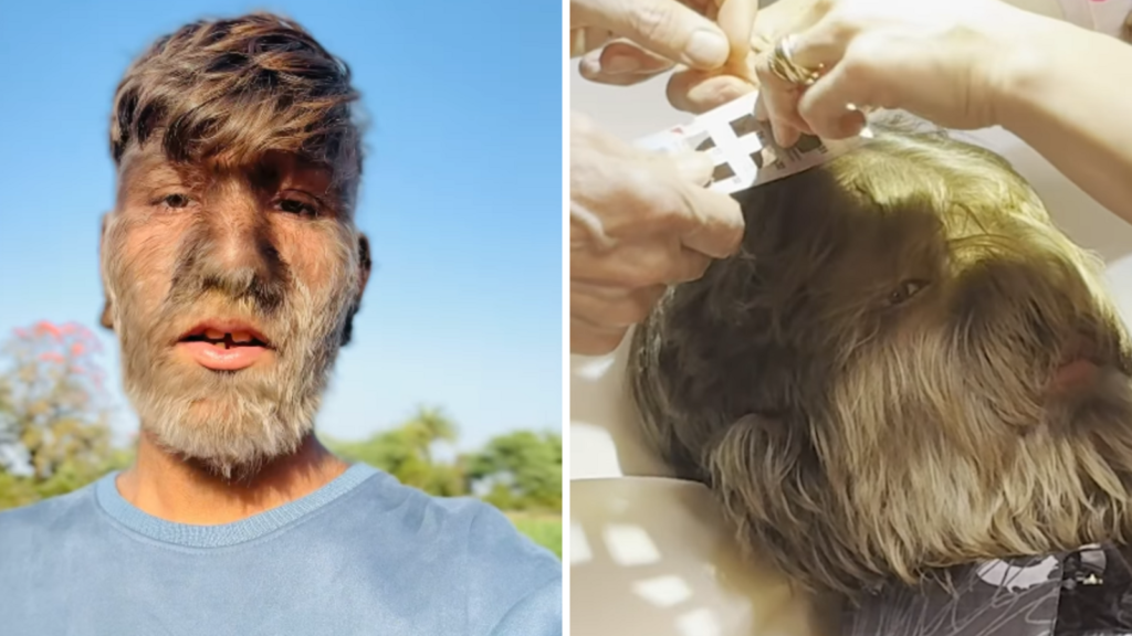 Indian teen with ‘werewolf syndrome’ sets Guinness World Record for hairiest face | Trending