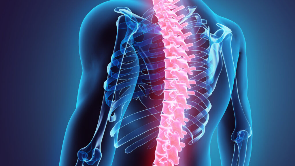 Is your spine curving? Here’s how to spot scoliosis early and avoid serious health issues | Health