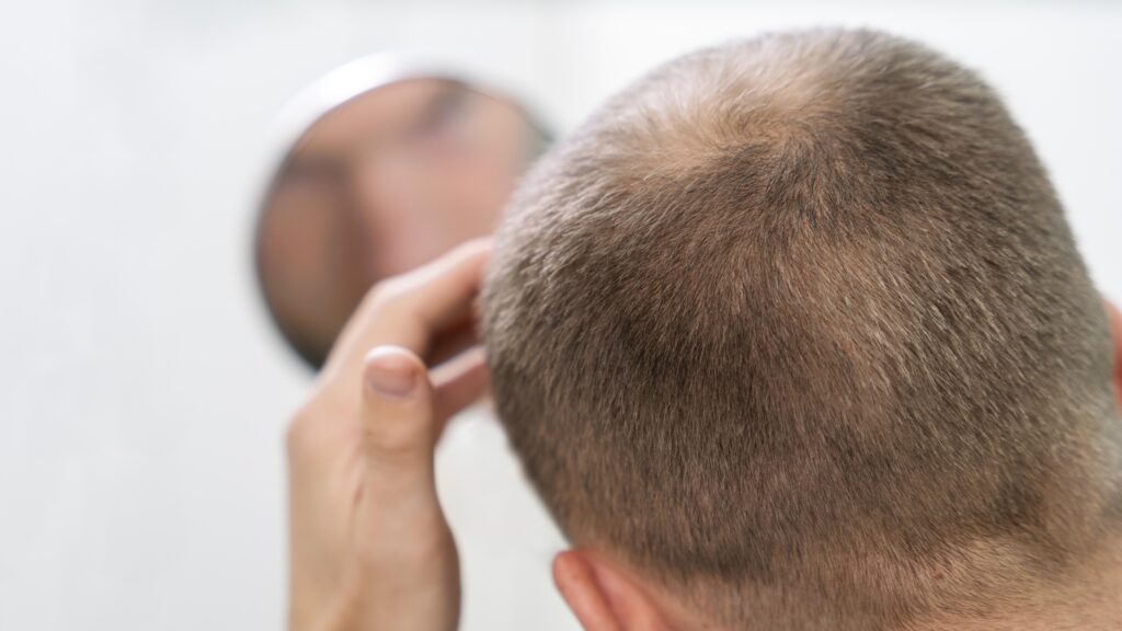 Minoxidil: The cutting-edge hair loss treatment that’s actually a repurposed drug from 1990s | Health