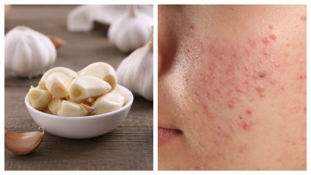 Should you rub garlic on your acne? Dermat answers, shares safe alternatives for quick healing | Health