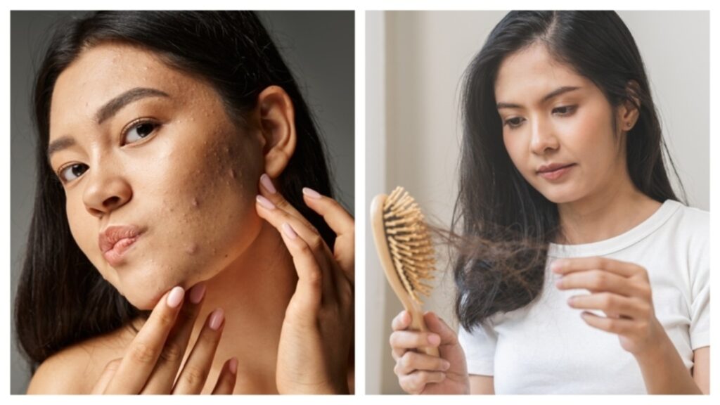 Struggling with acne and flaky scalp? Watch out for these triggers that cause common skin, hair problems in women | Health