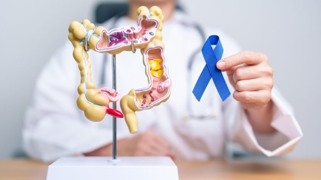 Childhood exposure to bacterial toxin can trigger colorectal cancer: Study | Health