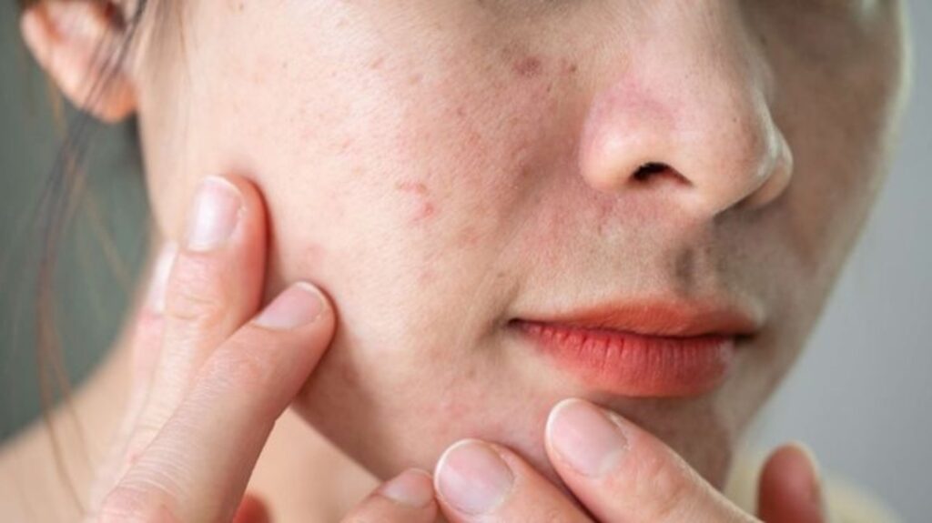 How to soothe irritated skin: 6 essential tips by experts | Health