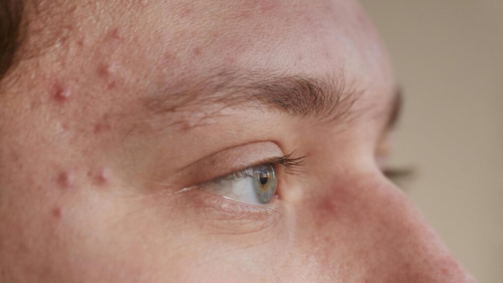 Man says coworker with flawless skin quit after he got a pimple: ‘He called it a health issue’ | Trending