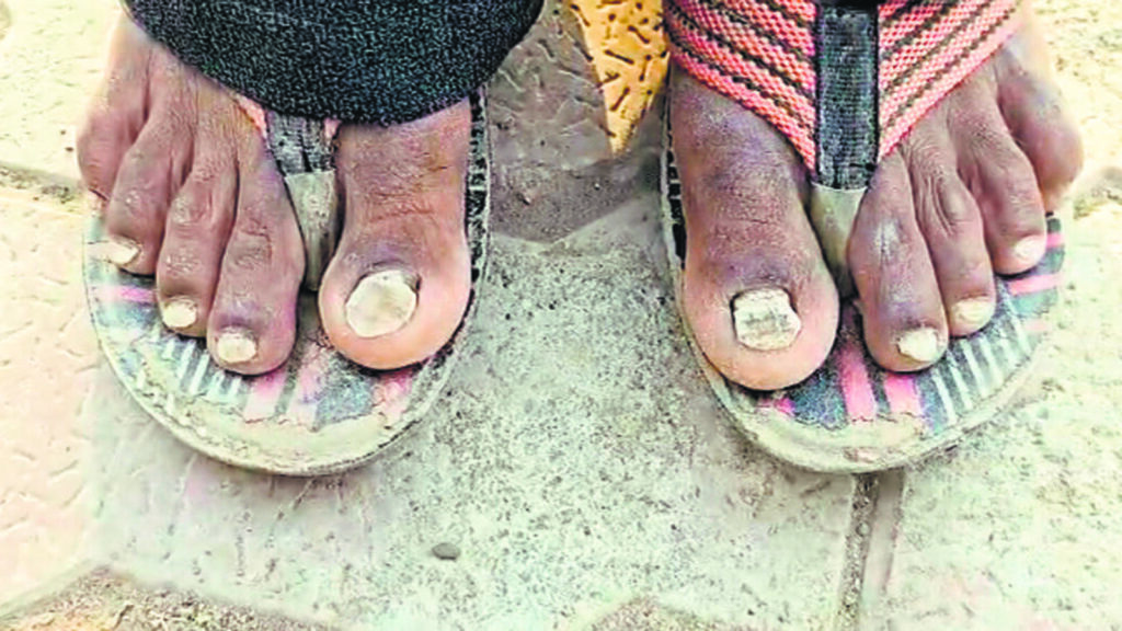 Mysterious malady in Buldhana: After hair loss, villagers lose nails | Mumbai news