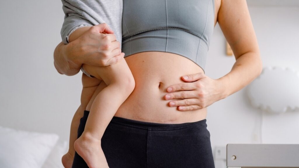 Recently had a C-section? Doctor shares 5 tips to manage postpartum pain | Health
