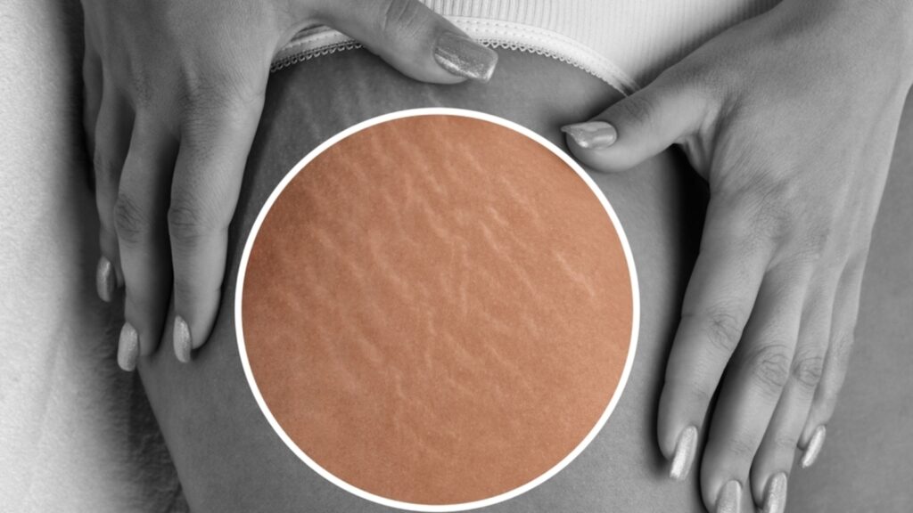 Say goodbye to expensive creams for stretch marks: Doctor shares 2-step simple method | Health