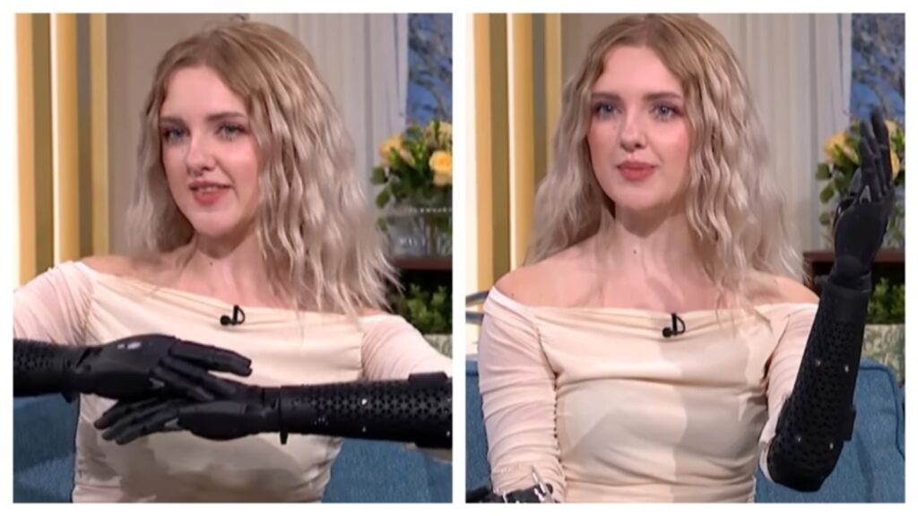 Sci-fi moment becomes reality: 19-year-old wears world’s most advanced bionic arms that move on their own when detached | Health