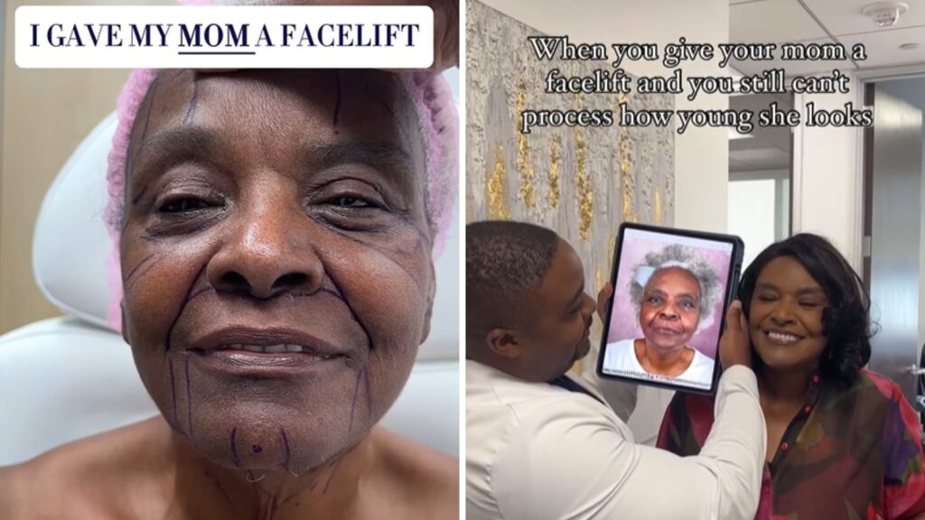 Beverly Hills plastic surgeon gives ₹1 crore facelift to his 68-year-old mom: ‘She looks 25 years younger’ | Trending