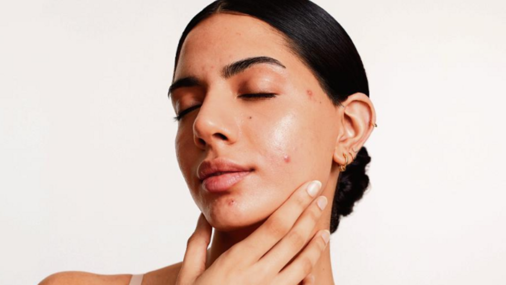 Everything you need to know about adult acne