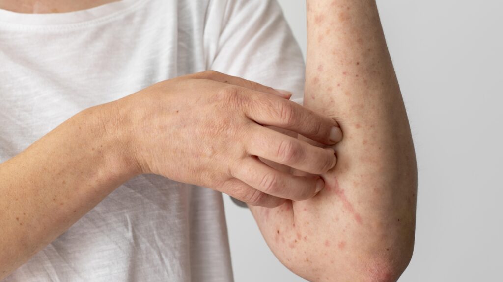 Having skin blisters in summer? It can be photodermatitis; dermat shares symptoms, causes and prevention tips | Health