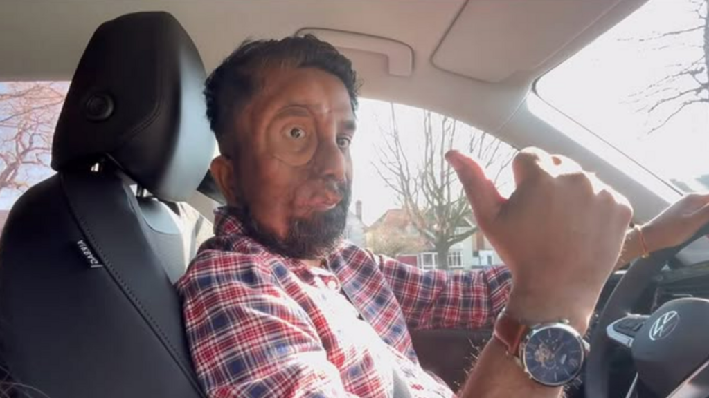 Indian-origin man with rare disorder claims London cafe denied him service: ‘Like they saw a ghost’ | Trending